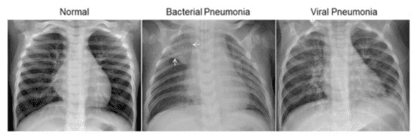 Chest X-ray samples from the dataset